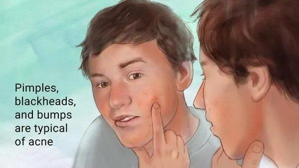 How To Deal With Hormonal Acne