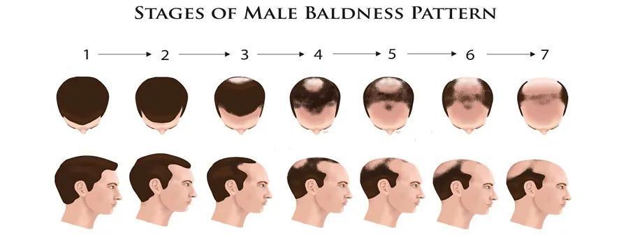Dermatologist Treatment of Male Pattern Baldness (MPHL)
