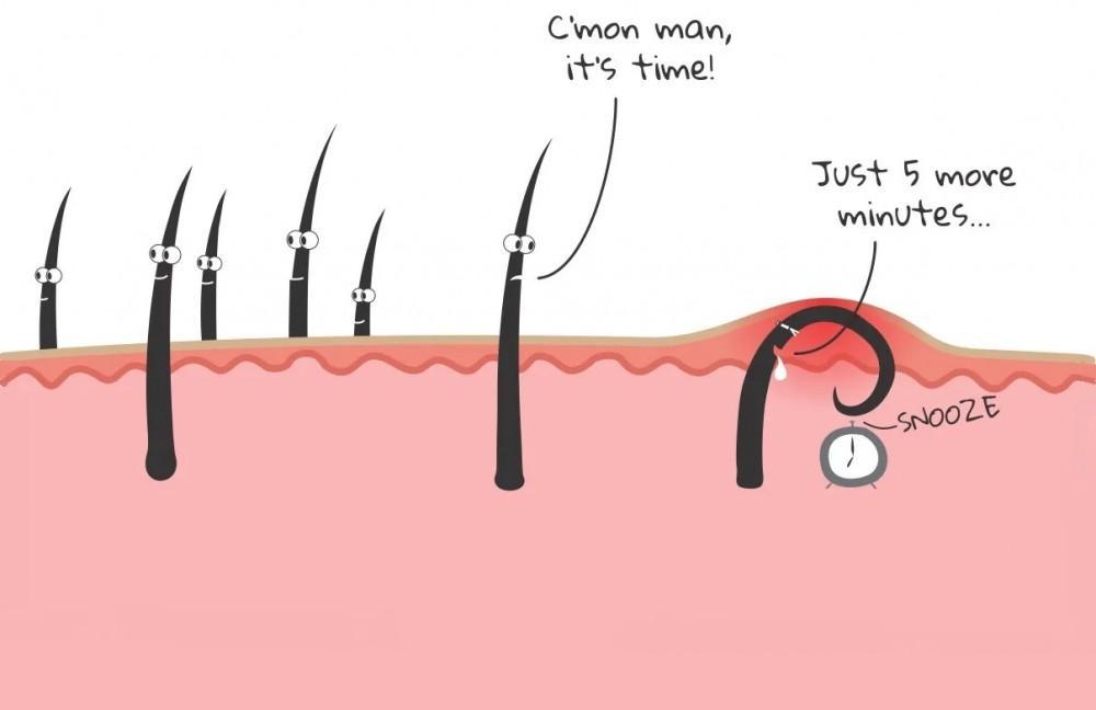 Removal of Ingrown Hair Cysts