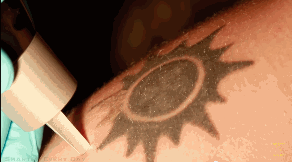 How Tattoo Removal Works