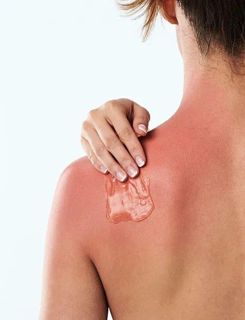 Summer Skincare Problems You Can Prevent