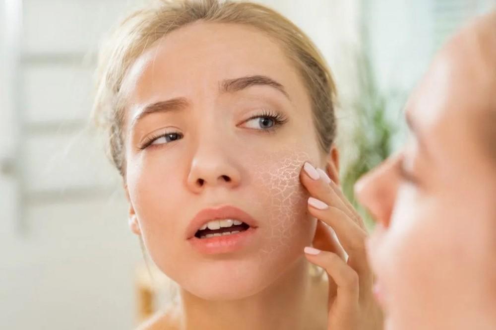 5 Skincare Tips For Winter Dry Skin