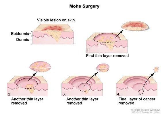 Skin Cancer Facts: More Than 600 Floridians Die of Melanoma Every Year!