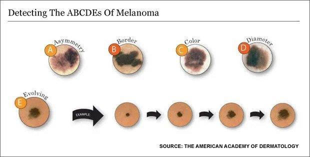 5 Signs That Mole Might Be Cancerous
