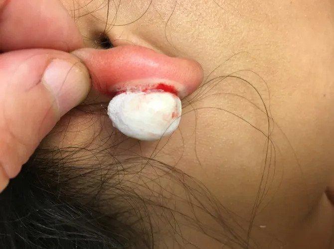High Tech Keloid Treatments that Actually Work!