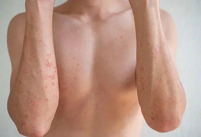 What Causes Atopic Dermatitis In Adults?
