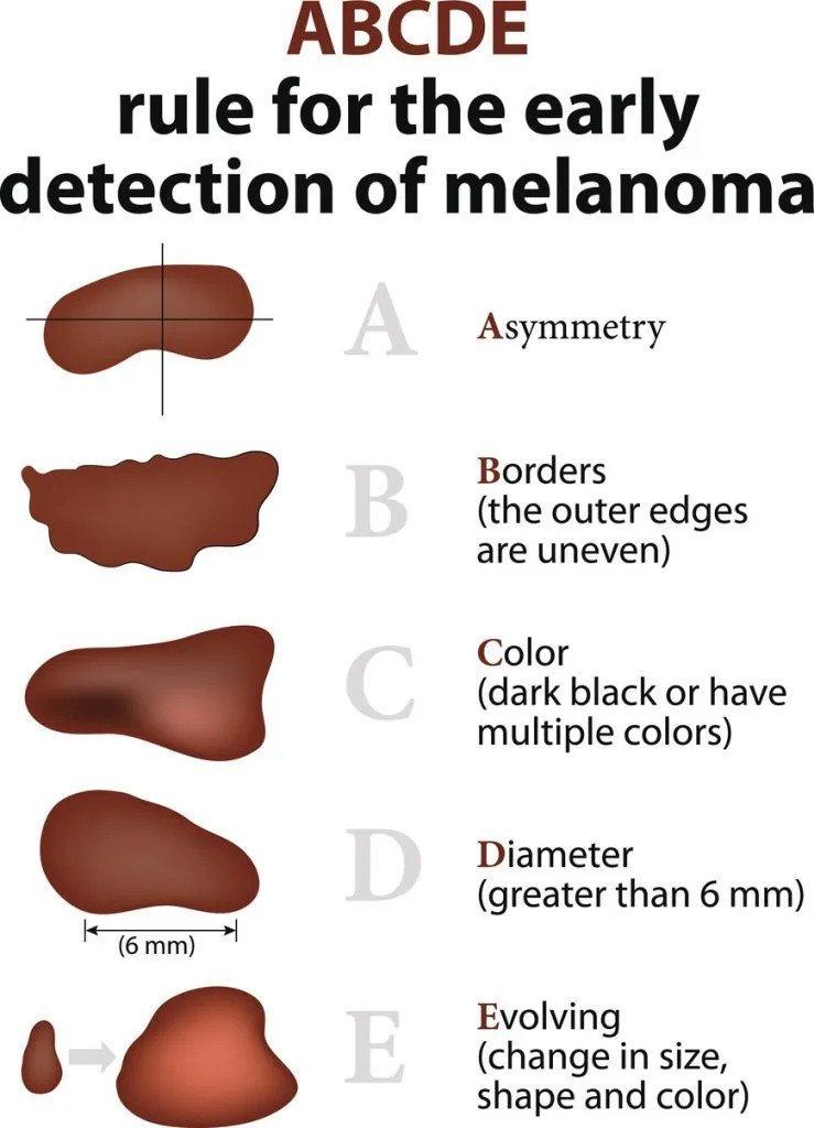 The ABCDE's of Skin Cancer Identification