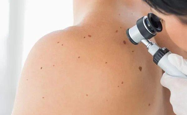 The Importance of Regular Skin Exams: Detecting Skin Cancer Early for Successful Treatment
