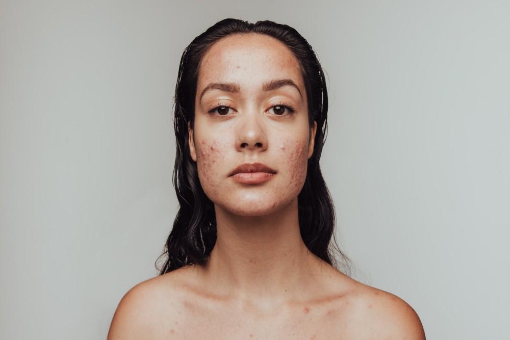 My Acne is Embarrassing: Can You Help?