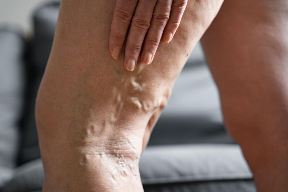 Will My Unsightly Veins Eventually Go Away on Their Own?