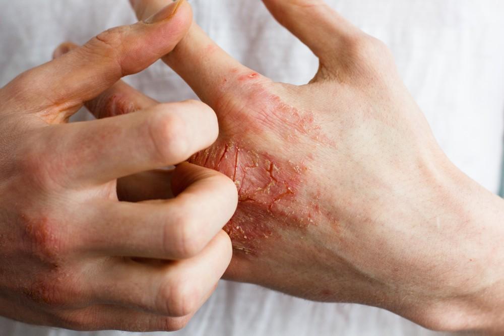 5 Common Eczema Triggers — And What to Do About Them