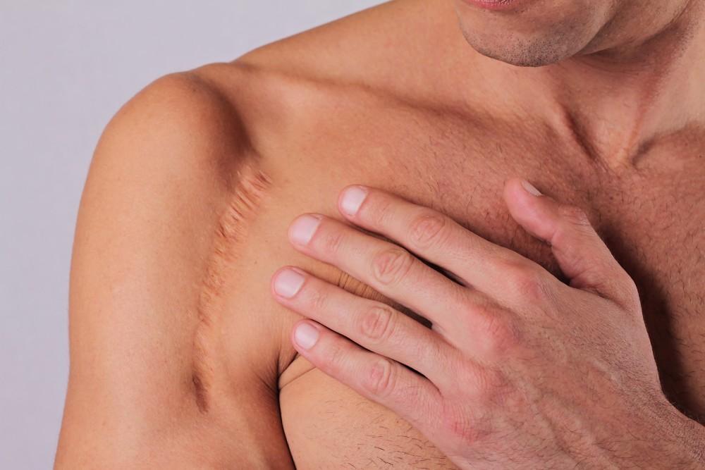 All About Superficial Radiation Therapy (SRT) for Scars