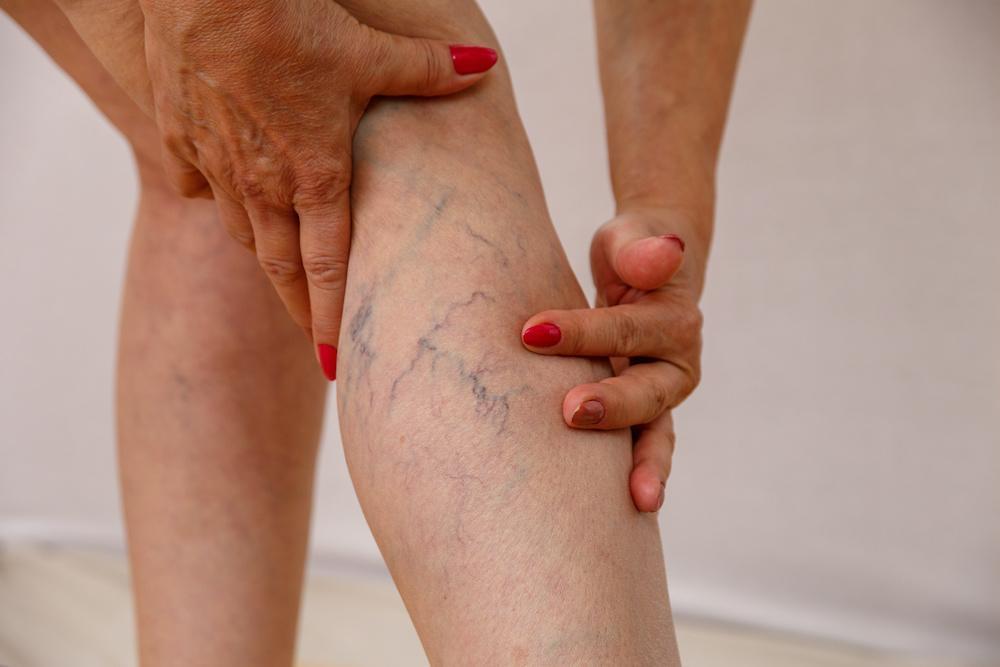Are My Varicose Veins a Health Concern?