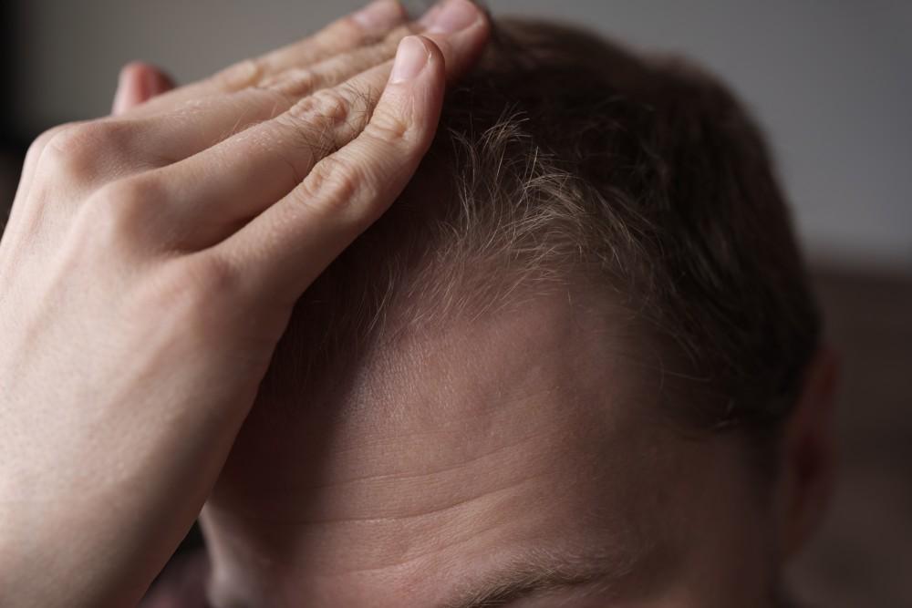 Androgenetic Alopecia: Understanding Your Treatment Options for Male-Pattern Hair Loss