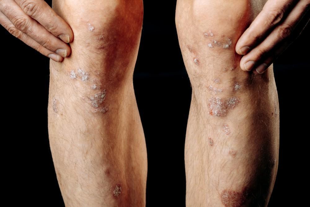 4 Possible Psoriasis Complications (and How to Reduce Your Risk)