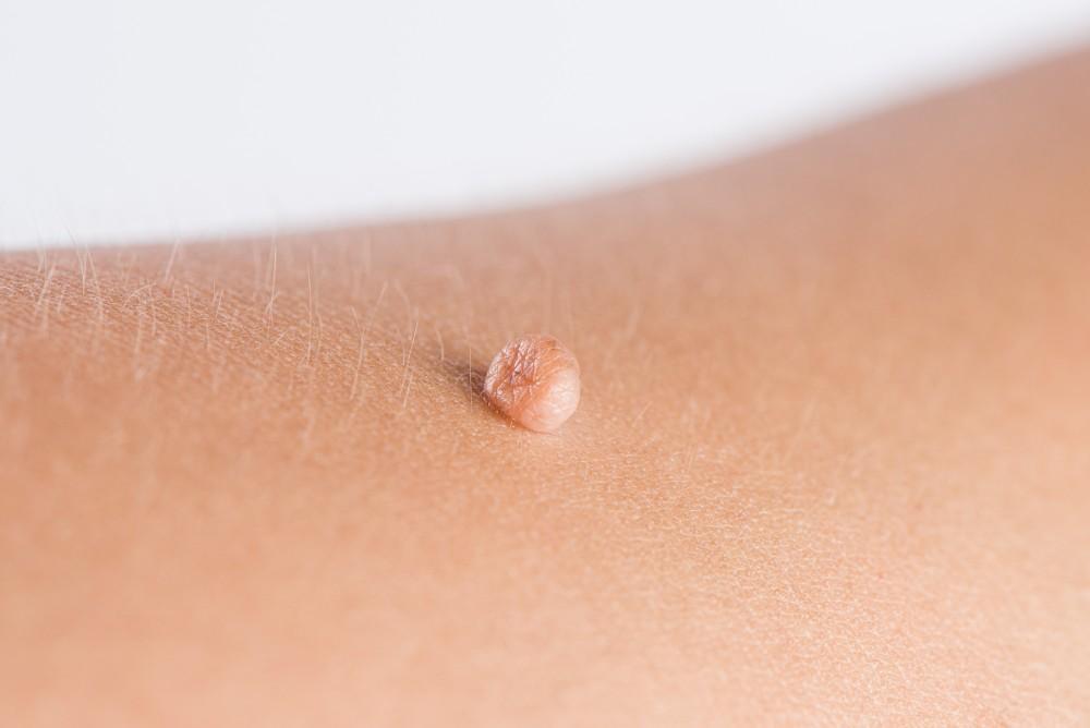 Where Did These Skin Tags Come From?