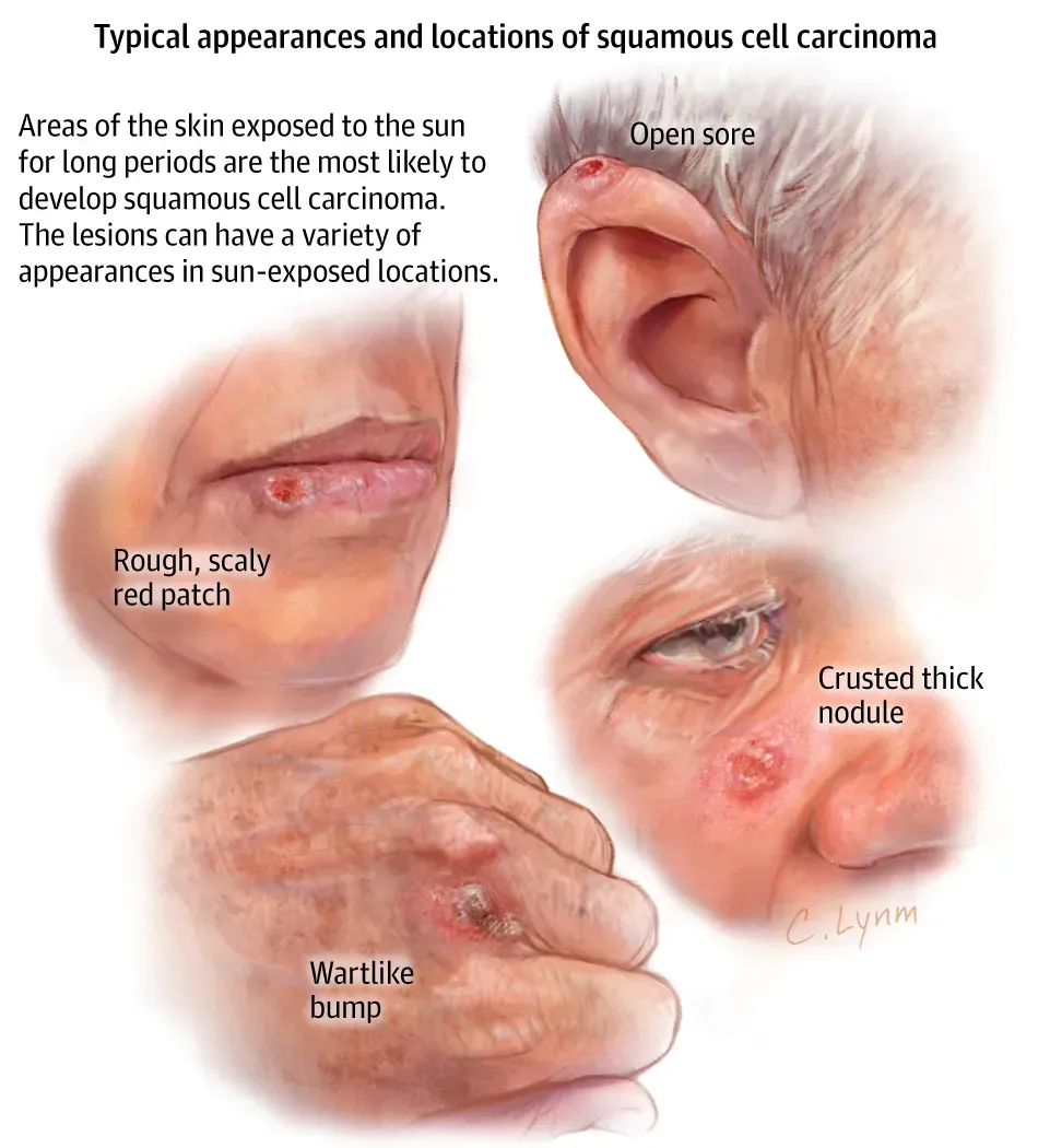 Identifying Squamous Cell Carcinoma