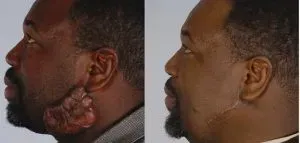 Keloid Scar Surgery & Removal