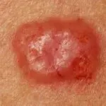 Basal Cell Carcinoma: A Highly Curable Cancer If Treated Early!