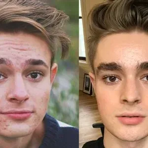 Is Accutane Useful, Safe, And Effective?