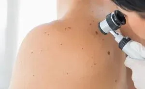 How Often Should You Get A Skin Cancer Screening?
