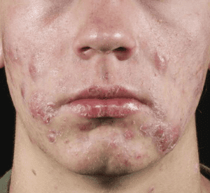 The Ultimate Solution to Cystic Acne