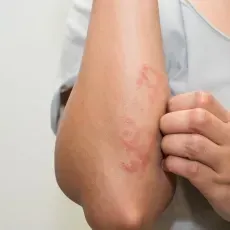 Cold Weather Eczema: How To Treat It