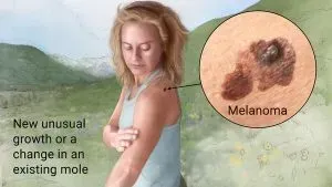 What is Melanoma?
