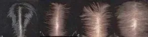 Thinning Hair and Hair Loss in Women (FPHL)