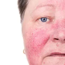 Dermatologist's Advice: Living with Rosacea