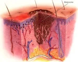 Understanding Melanoma: Causes and Treatment