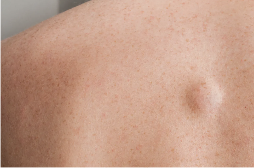 Lipoma