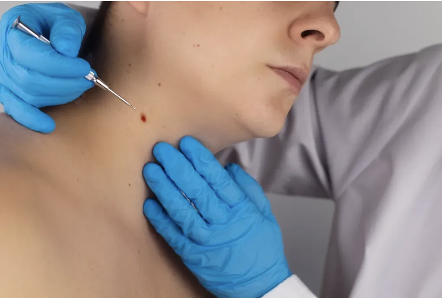 Mole Check & Removal